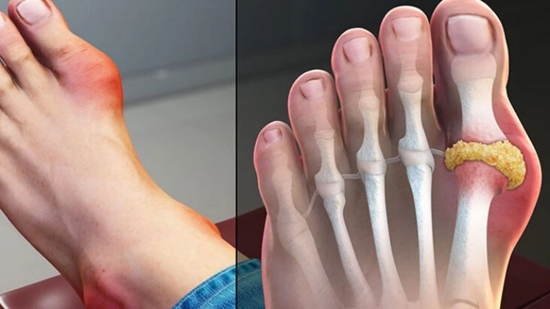 Bệnh gout (gút) hay còn gọi thống phong