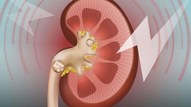 Bệnh sỏi thận là hiện tượng bị lắng cặn muối và khoáng chất bên trong thận
