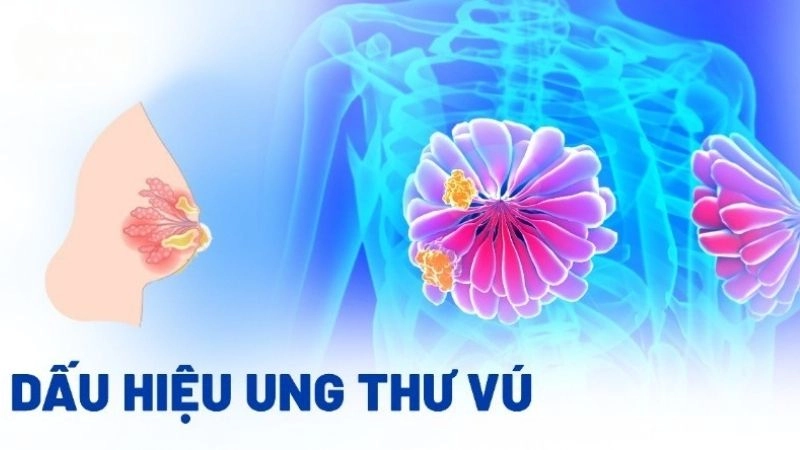 Dấu hiệu ung thư vú sớm dễ nhận biết nhất