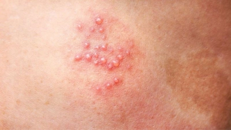 ệnh zona thần kinh nếu được điều trị sớm và đúng cách sẽ hết