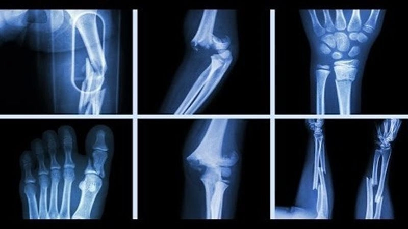 Gãy xương sống có nguy cơ gây áp lực và tổn thương tủy sống 
