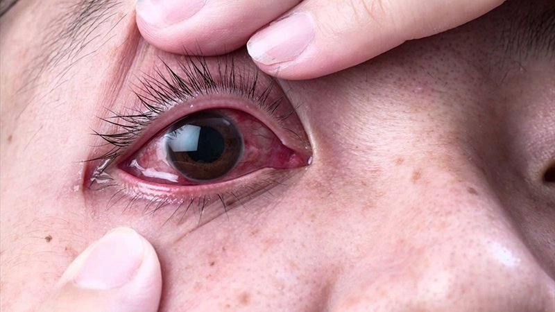Mắt đỏ là triệu chứng thường thấy do mắt dị ứng với những tác nhân gây kích ứng