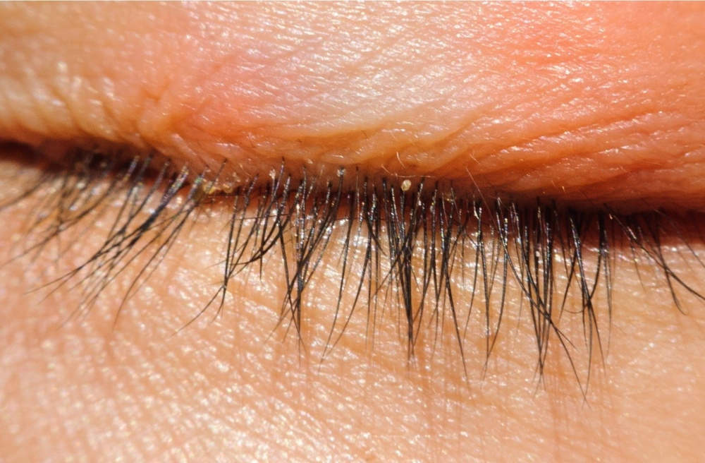 Viêm bờ mi điều trị đúng giúp cải thiện sớm