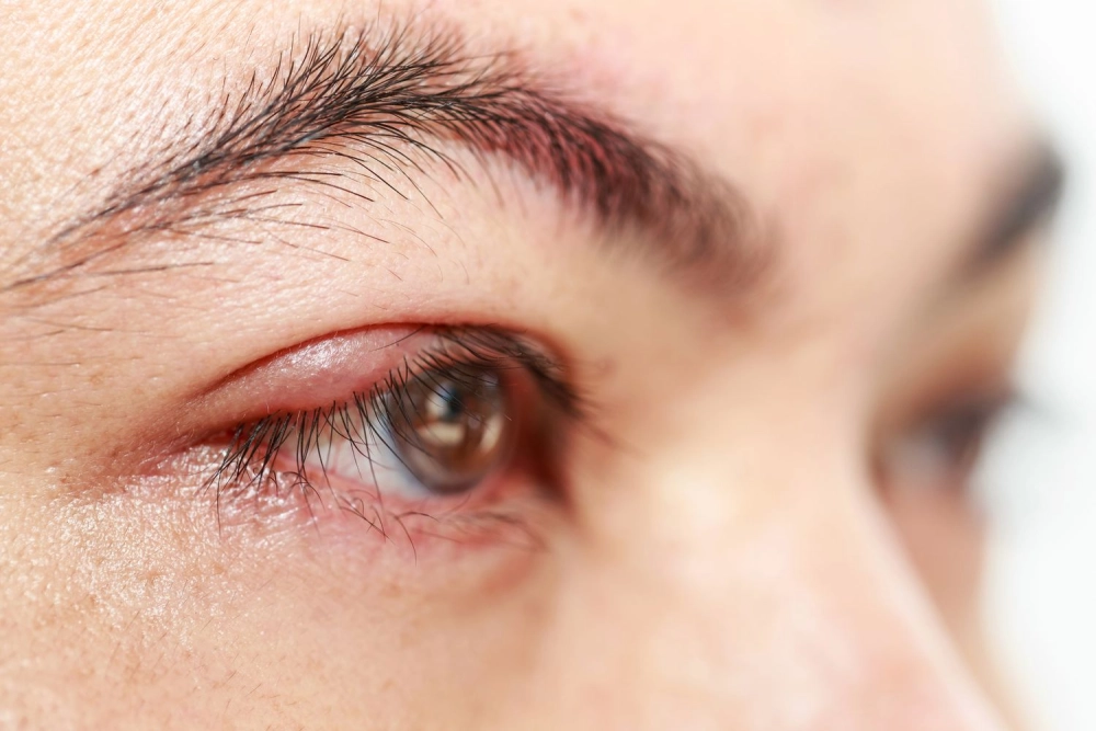 Viêm bờ mi do vi khuẩn cần kiểm soát